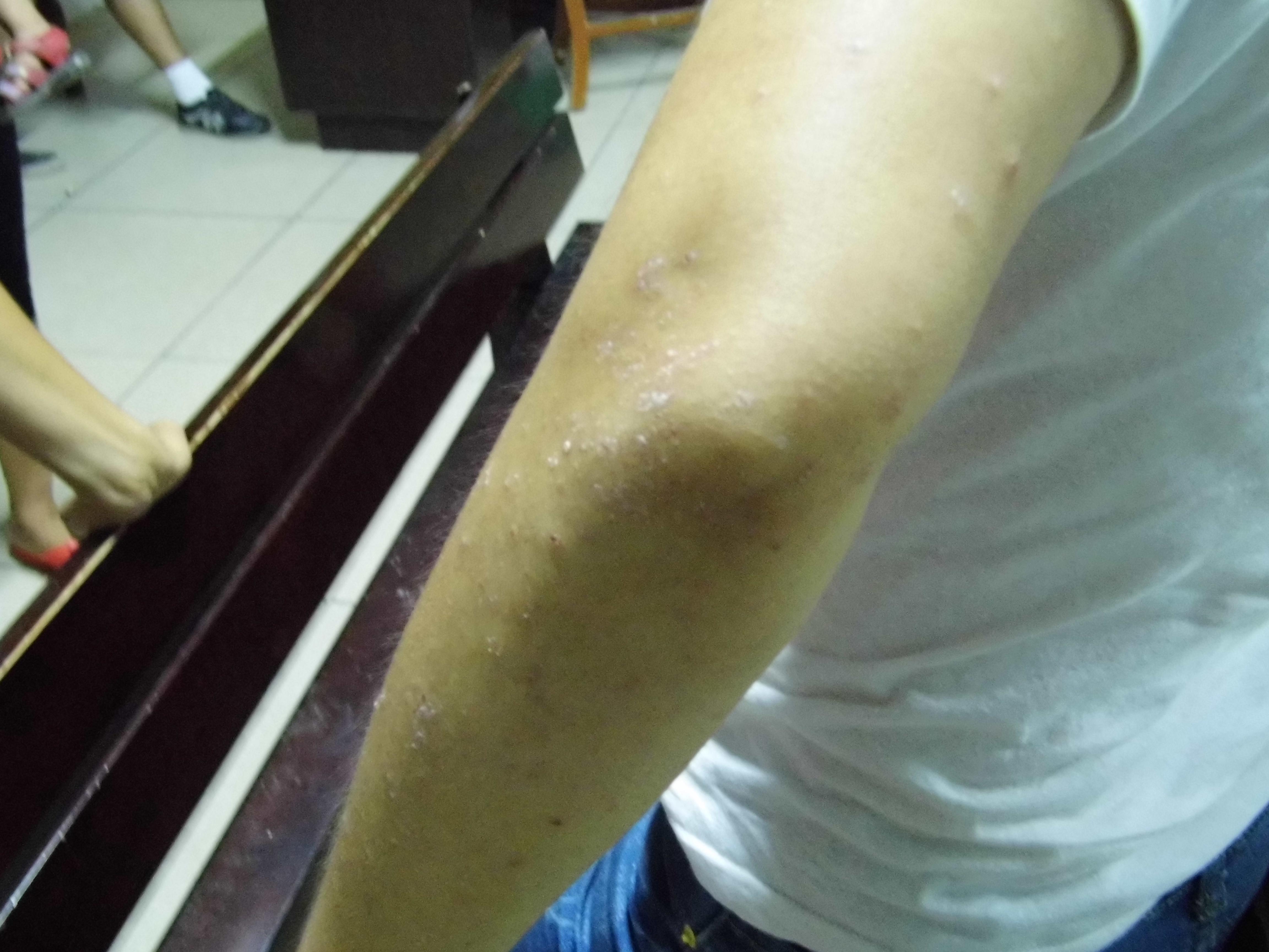 诺诚健华:ICP-488治疗银屑病II期数据在2025年美国皮肤病学会年会发布